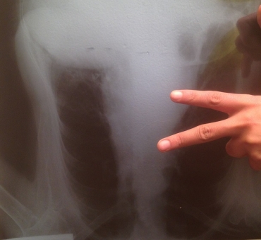 El derecho a la segunda opinión es ley